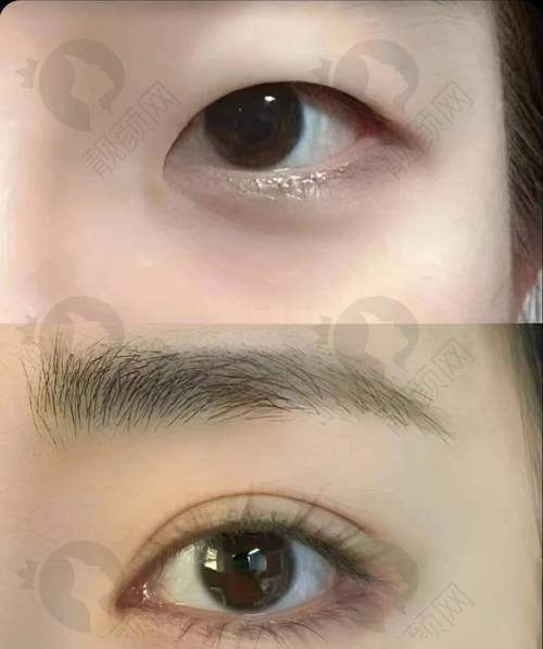 上海眼王张宇医生双眼皮手术实例