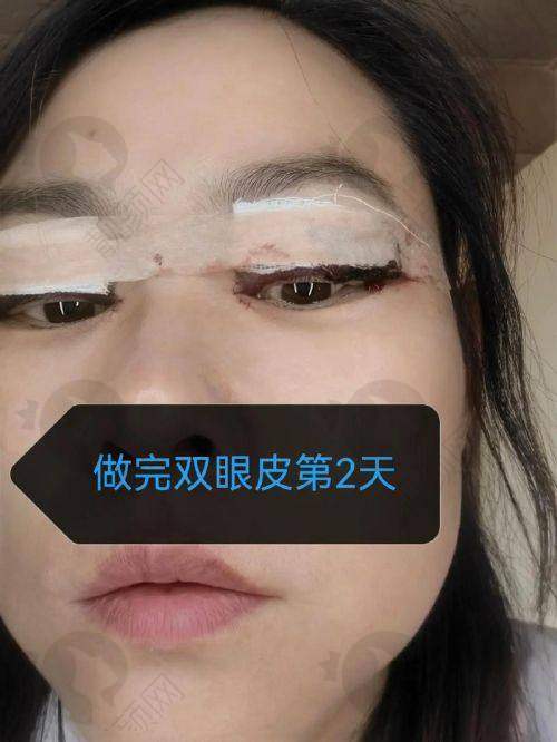 广州佳人医疗美容曾繁茂医生：眼鼻整形多面手