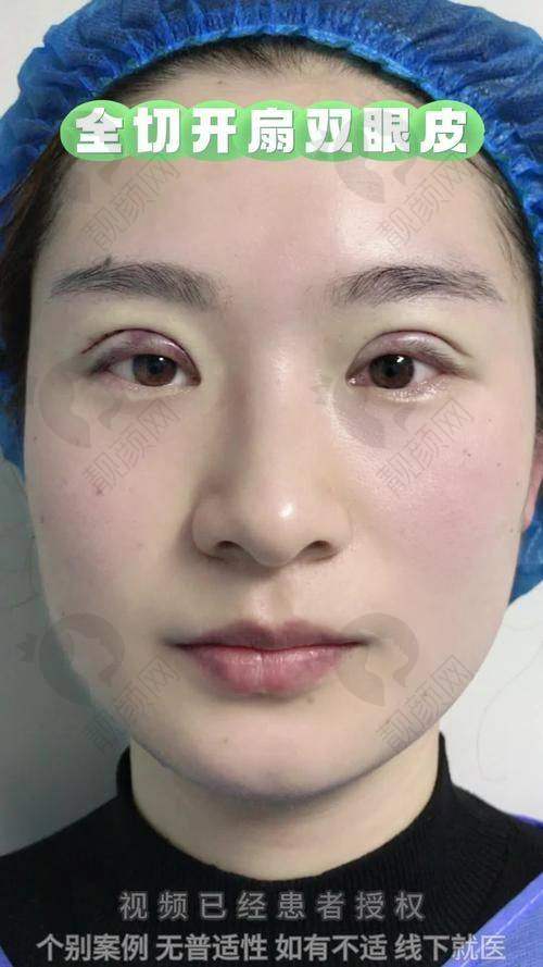 广州军美整形美容王世虎医生：双眼皮经验多