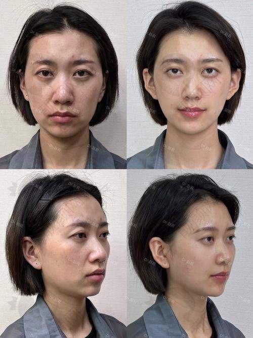陈伟瀚隆鼻项目价格表参考