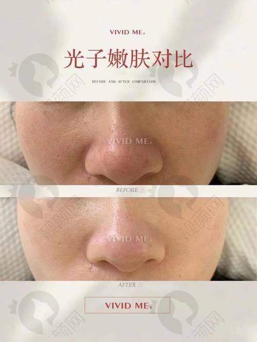 台州艺星黄金超光子的具体优势