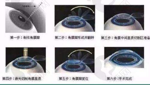 贵阳佰视佳眼科半飞秒价格之成功实例