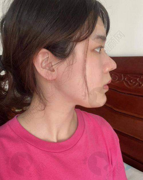 长沙雅美整形田芳斌做鼻子怎么样