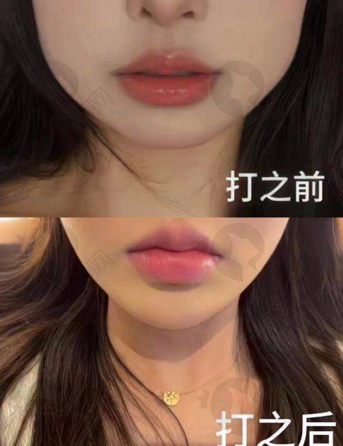 哈尔滨羽禅医疗美容打瘦脸项目优势