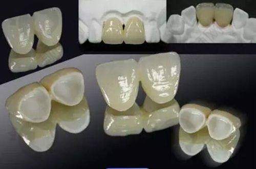 云阳众植博仕口腔金属托槽矫正具体优势