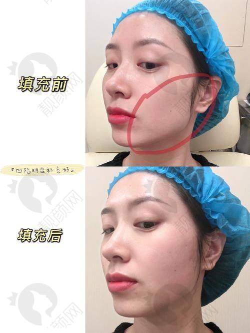 玻尿酸填充脸颊凹陷维持时间的实际实例分享