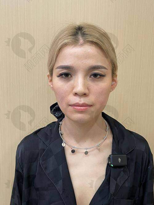 玻尿酸填充脸颊凹陷维持时间与成效的关系是怎样的？