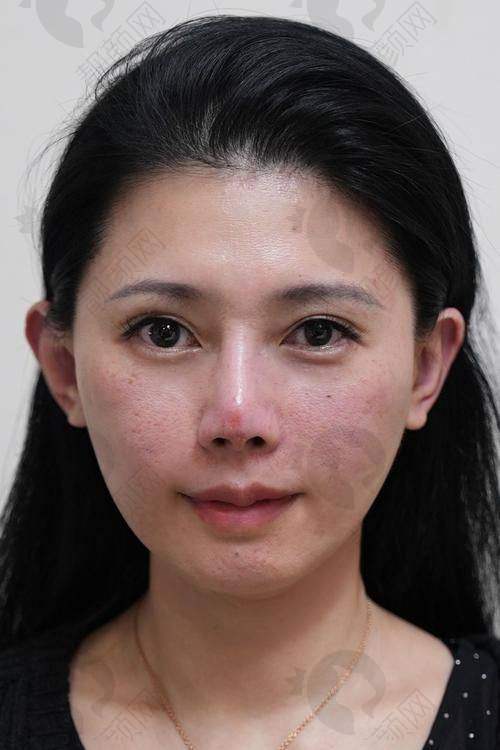 影响玻尿酸填充脸颊凹陷维持时间的因素有哪些？