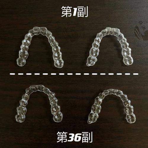 重庆云阳众植博仕口腔正雅隐形矫正的优势