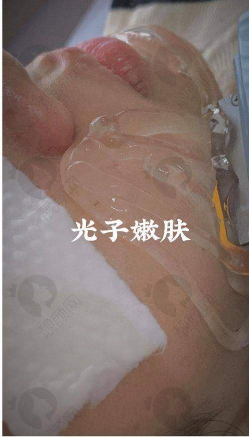 云南铜雀台整形医院光子嫩肤的具体优势