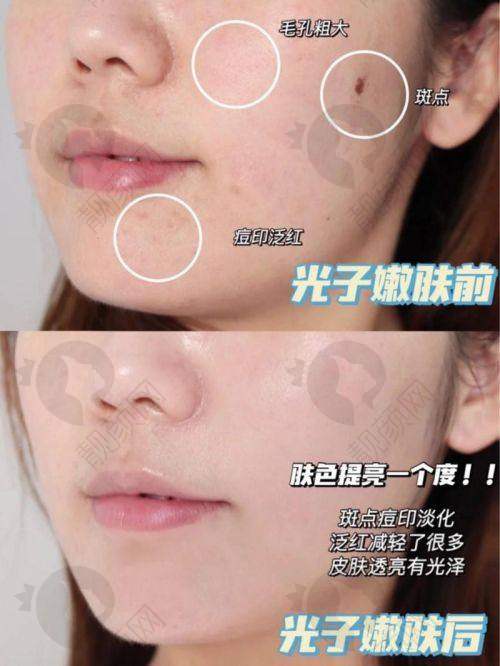 云南铜雀台整形医院光子嫩肤的真实评价