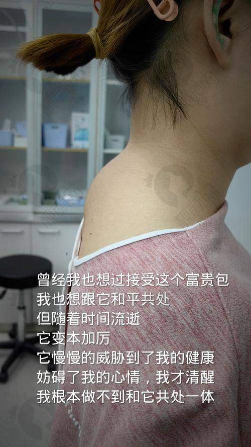 温州徐淑卿医生富贵包手术实例反馈好