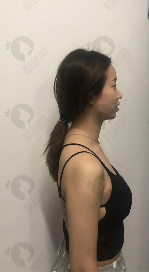 南京美莱曼托假体隆胸的优势