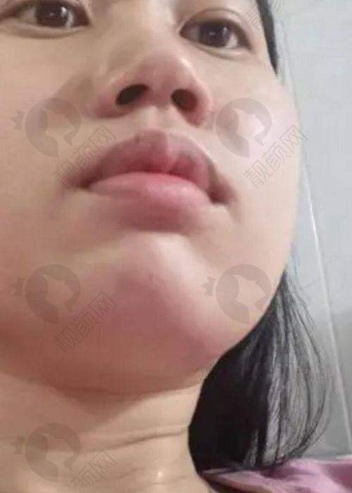酷塑冷冻溶脂能瘦多少：因人而异看脂肪量
