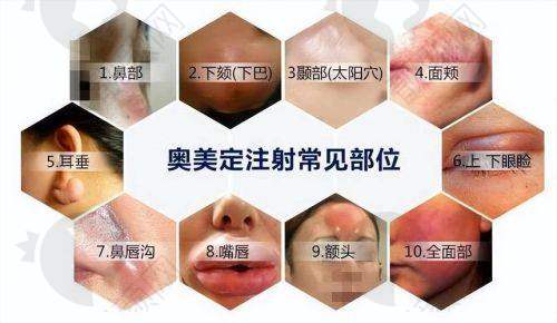 注射丰胸20年风险揭秘：风险依旧存在