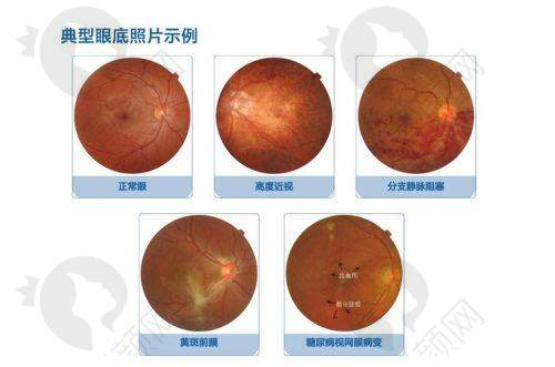 OCT精准提示后巩膜葡萄肿,清晰呈现病变形态范围,助力眼科诊疗方案精准制定