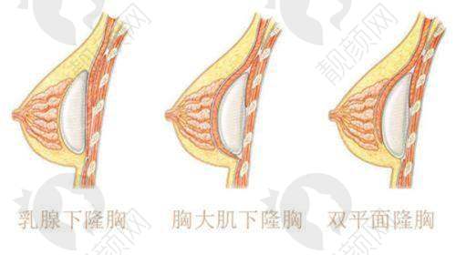 六、东莞爱思特（原华美）医疗美容门诊实例：