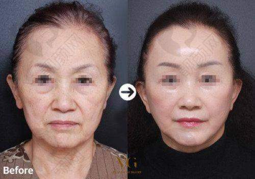 青岛知颜智妍医疗美容门诊部情人节特惠,切开双眼皮888元起,单部位除皱88元起!