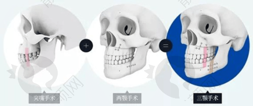 吸脂塑形项目