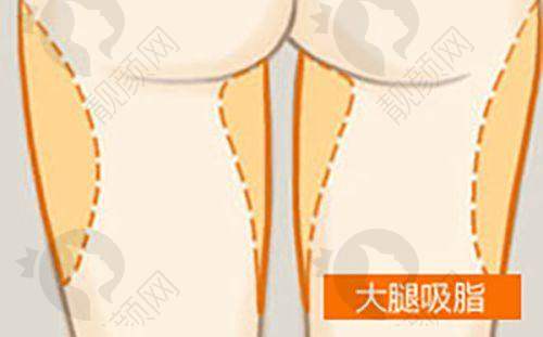 关于不剃发植发价格