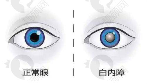 重庆沙坪坝百淼兴眼科：专精靠谱的白内障治疗机构