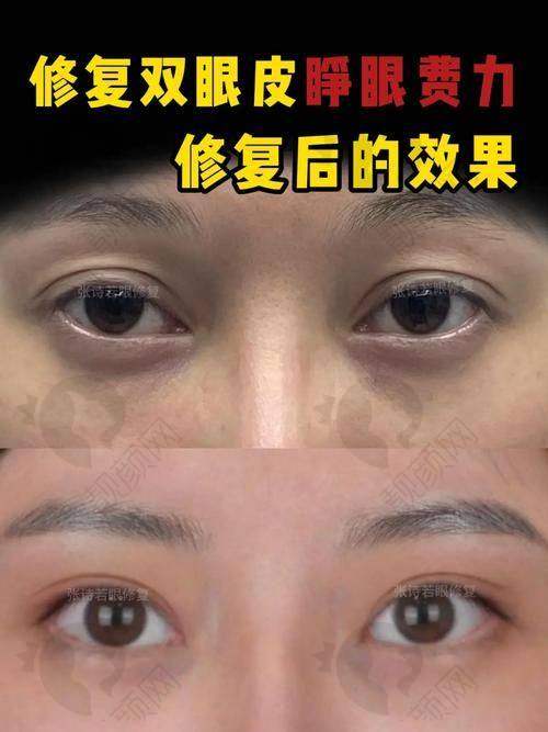 2025国内双眼皮修复五大骨干医生排名揭晓！魏志香医生与北京丽星翼美，自然美的代言人