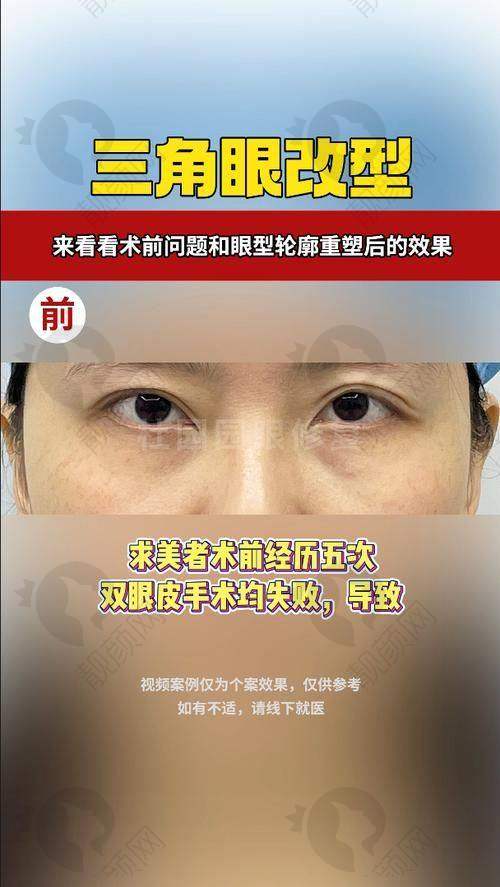 2025国内双眼皮修复五大骨干医生排名揭晓！郑永生医生与北京正美，高难度修复的一把好手