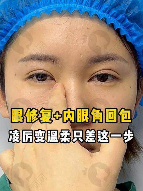 2025国内双眼皮修复五大骨干医生排名揭晓！刘志刚医生与大连爱德丽格，眼部修复的实力之选