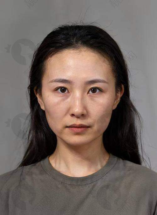 乔雅登美神针的良好注射成效