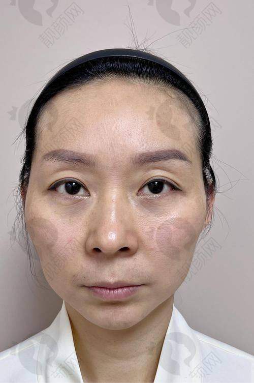 乔雅登美神针的持久维持成效