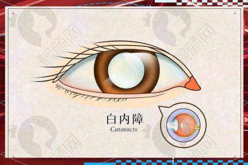 重庆华厦眼科医院：高品质服务的白内障治疗医院