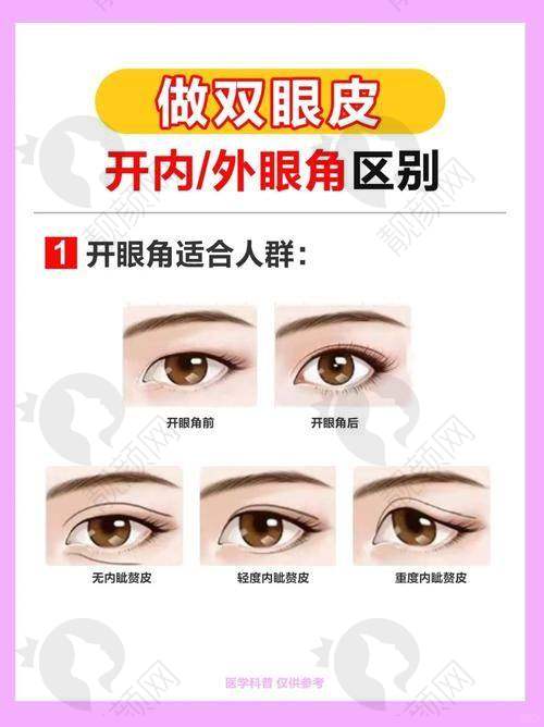 广州华美医院做眼睛好的医生：薛提朋——眼部整形多面手