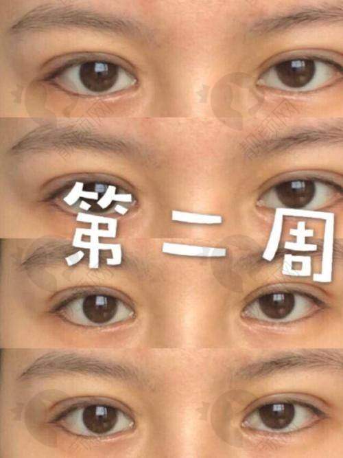 温州艺星黄乐双眼皮水平怎么样？