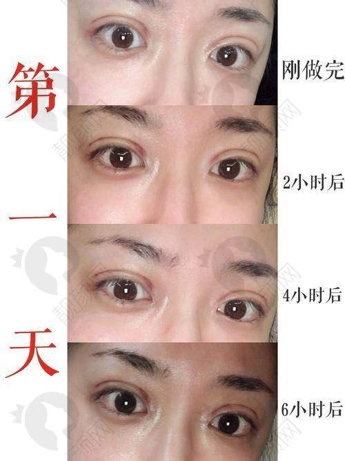 温州艺星黄乐双眼皮实例
