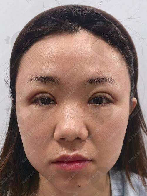 沈阳10大眼部整形医院排名公布！沈阳创美荟医疗美容门诊部——特色技术，术后无痕