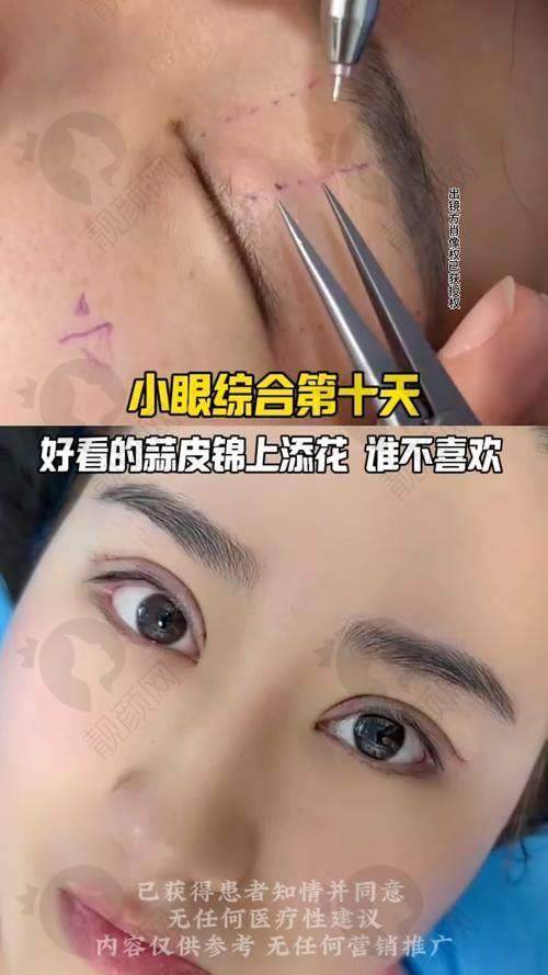 沈阳10大眼部整形医院排名公布！沈阳腾采医疗美容门诊部——微创特色，修复快速