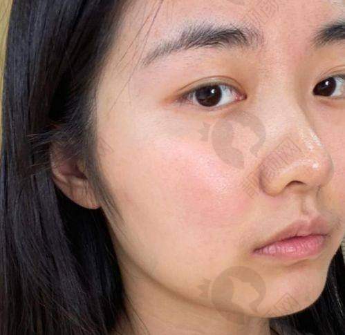 襄阳韩美光子嫩肤真实评价