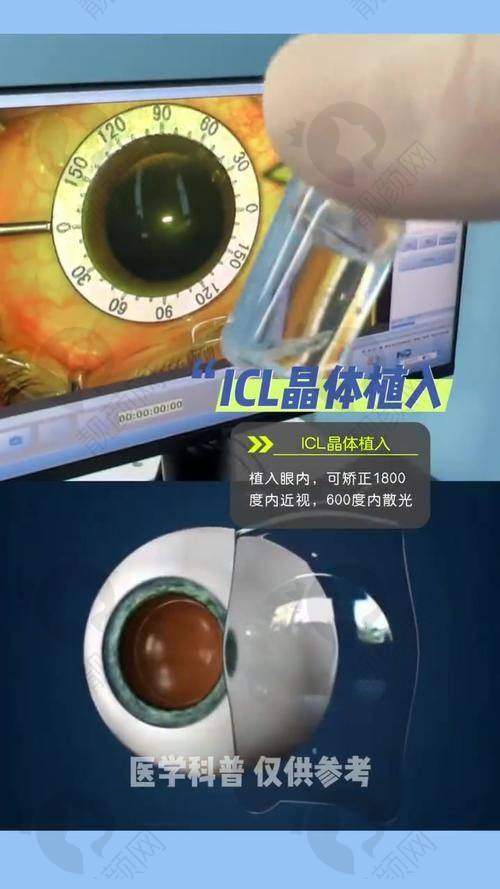 重庆华厦眼科TICL晶体价格:性价比之选