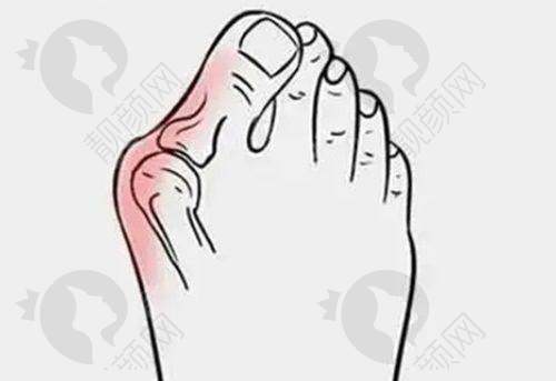 北京马文足科5D微孔祛大脚骨手术优势