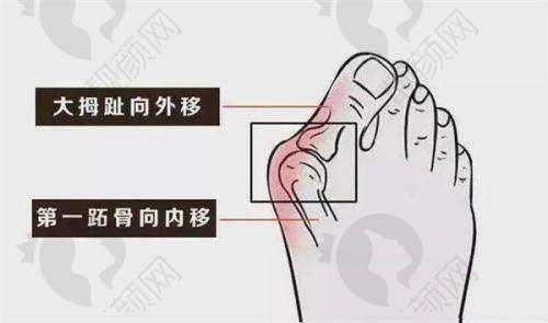北京马文足科5D微孔祛大脚骨手术真实评价