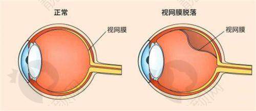 辛集复明眼科医院全飞秒手术的口碑评价