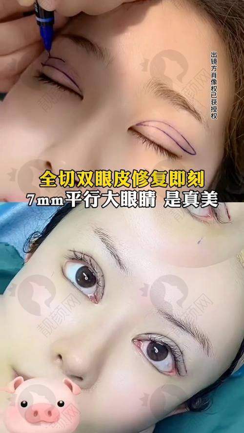 冯少清医生手术价格表