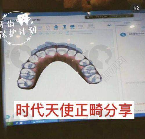 杭州雅乐口腔隐形牙齿矫正的具体优势