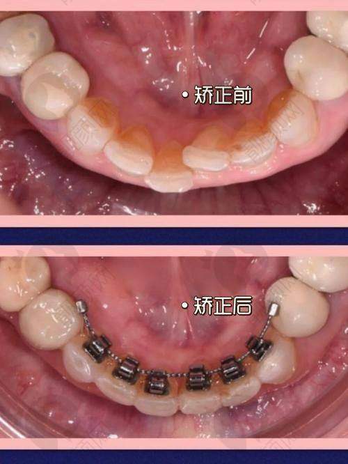 孔卫东医生舌侧隐形矫正水平怎么样？