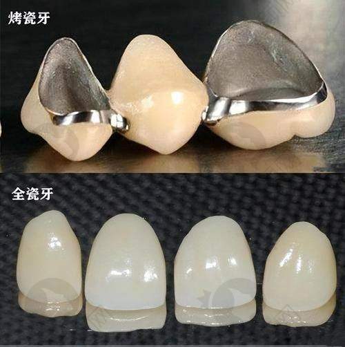 瑞士西捷美牙冠：性价比高不高？
