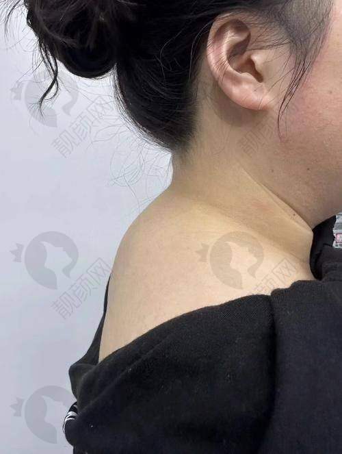 叶桐江脂肪整形水平怎么样？