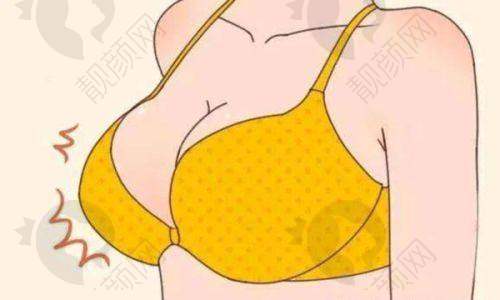 惊艳！曼托 275cc 假体隆胸的纠结与决定