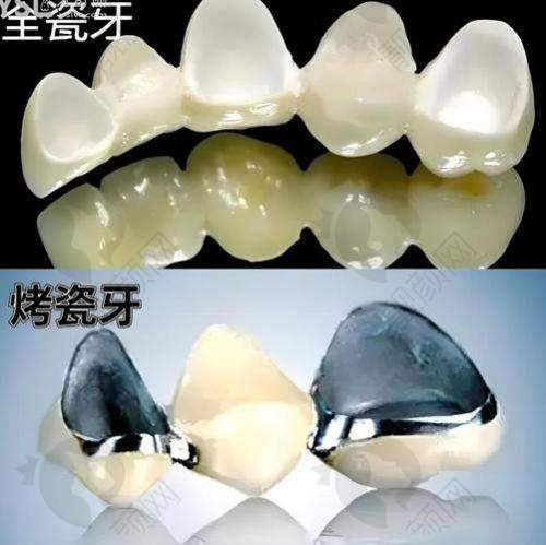 西捷美牙冠质量究竟好不好？高仿真度美学性能超棒