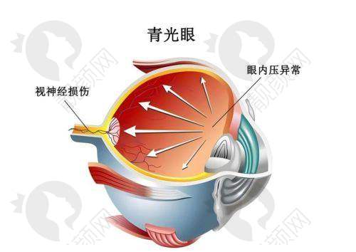 株洲做青光眼的眼科医院有哪些？株洲爱尔与仁和医院开展的青光眼项目