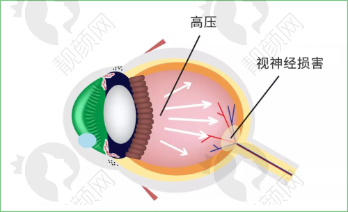 株洲做青光眼的眼科医院有哪些？株洲爱尔与仁和医院口碑评价
